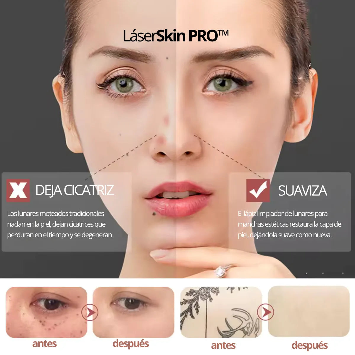 LÁSERSKIN PRO™ CAUTERIZADOR ELIMINA LUNARES, MANCHAS Y VERRUGAS EN SEGUNDOS